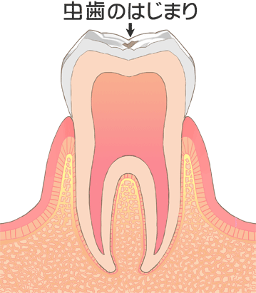 虫歯の前兆　C0