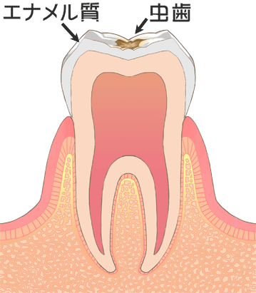 軽度の虫歯　C1