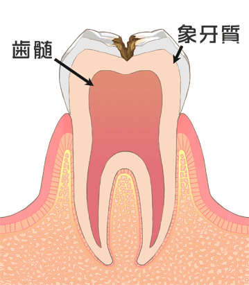 中度の虫歯　C2
