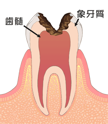 重度の虫歯　C3