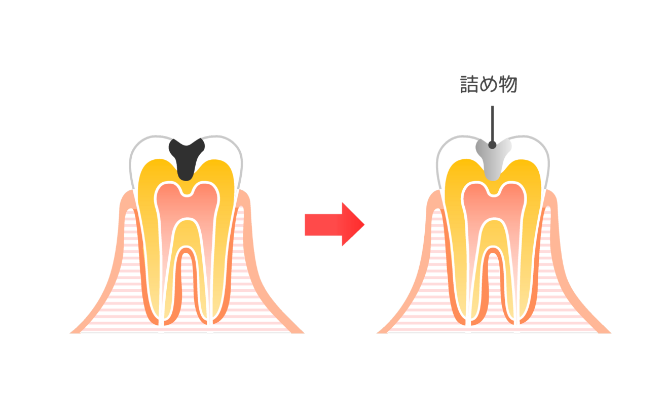 中度の虫歯（C2）の治療について