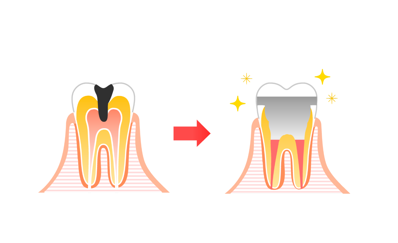 重度の虫歯（C3）の治療について