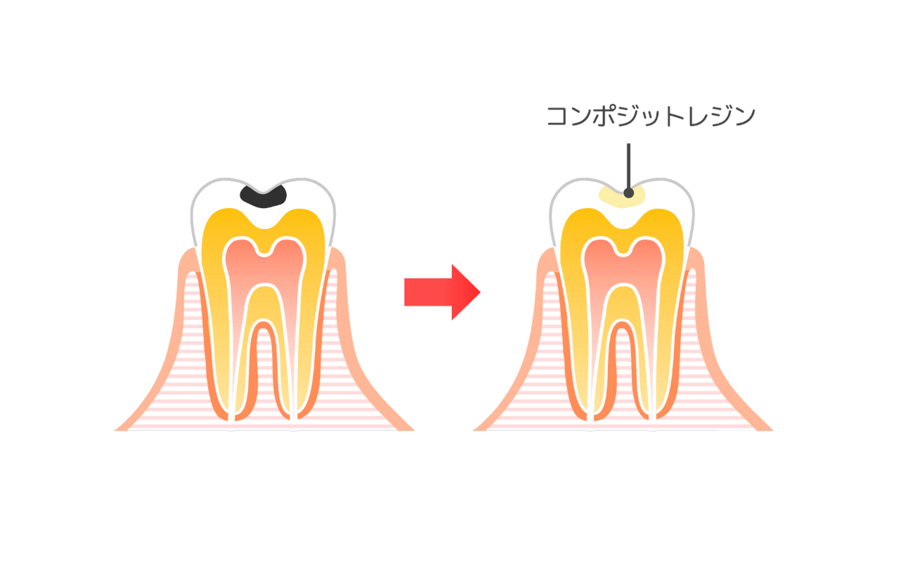 軽度の虫歯（C1）の治療について