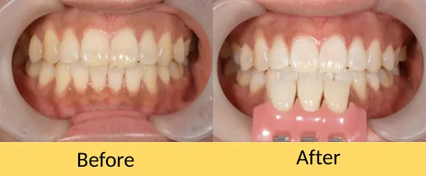 治療前後の口内と歯
