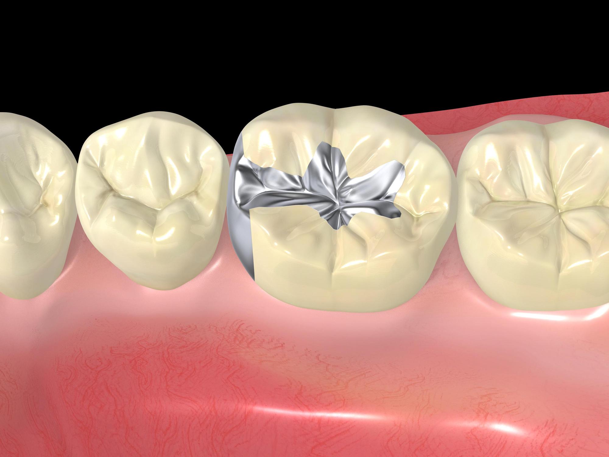 せたがや歯科室｜歯科医師ブログ｜小さい虫歯の治療には「CR（コンポジットレジン）」｜金属の詰め物のイメージ画像