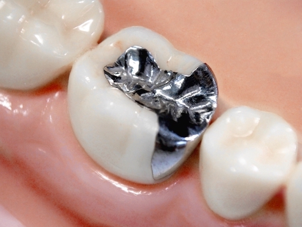 "せたがや歯科室｜歯科医師ブログ｜きれい、丈夫、メタルフリーな白い詰め物「E-max」とは｜銀歯のイメージ画像