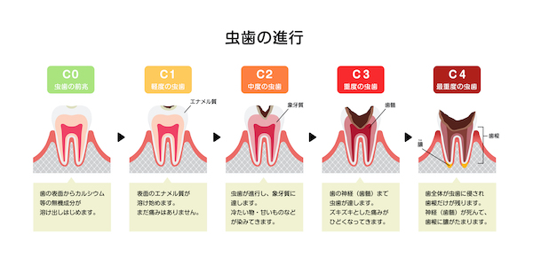 せたがや歯科室｜歯科医師ブログ｜痛い虫歯と、痛くない虫歯がある？虫歯の進行ステップ｜虫歯の進行レベルのイメージ画像