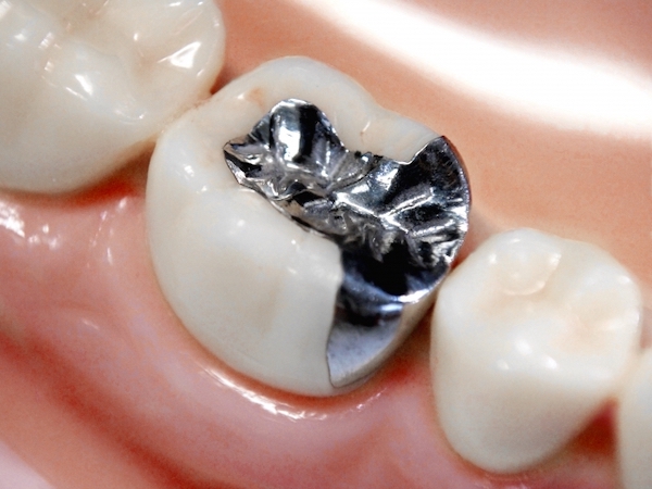 せたがや歯科室｜歯科医師ブログ｜大きな詰め物に使う「銀歯」メリットとデメリット｜治療後の銀歯のイメージ画像