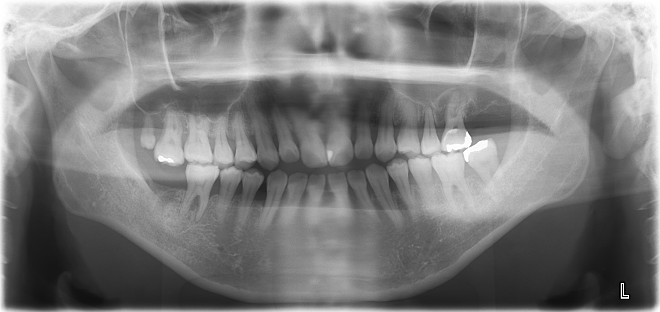 骨を回復させる歯周組織再生療法、治療前のレントゲン画像｜松陰神社の歯医者 せたがや歯科室