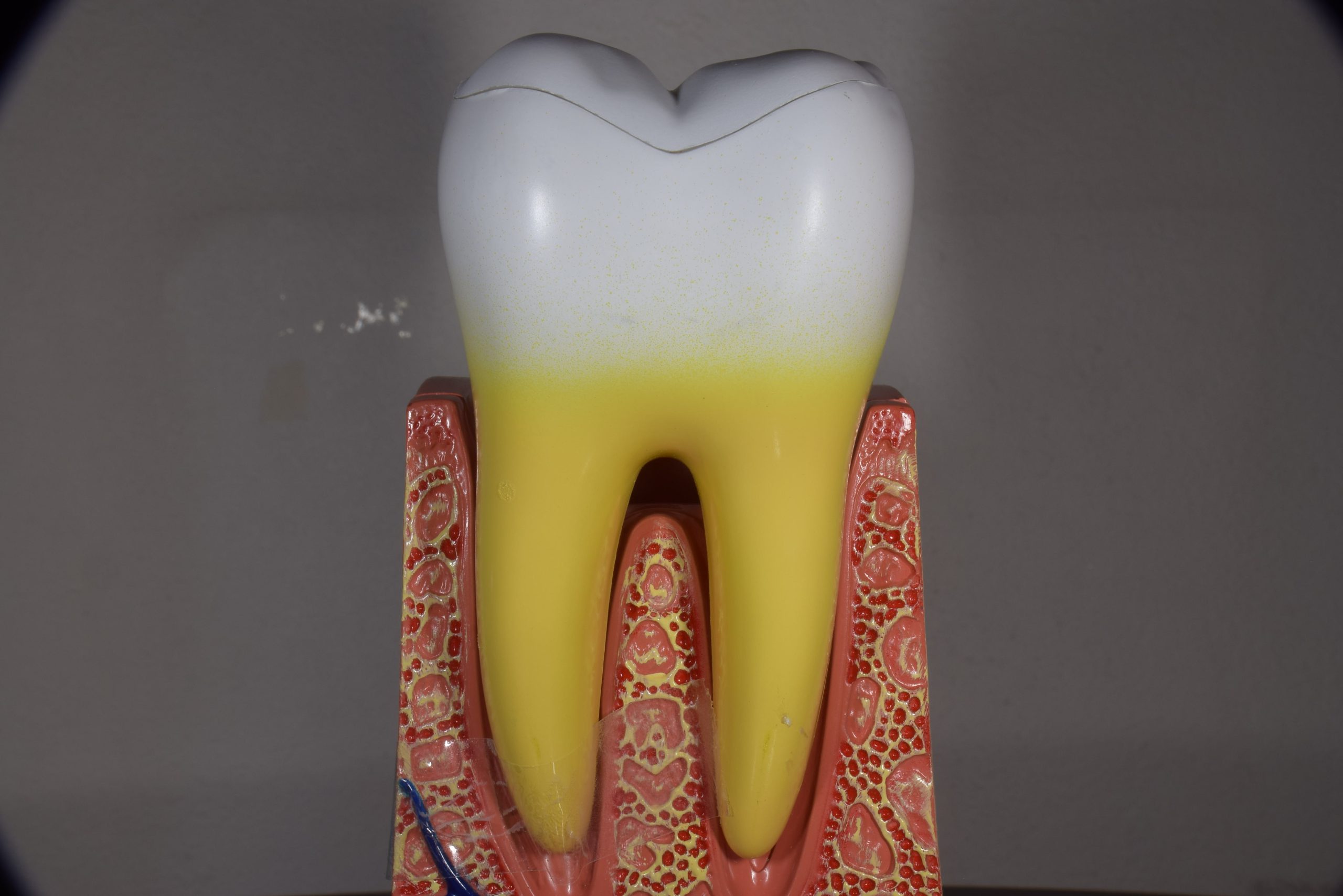 骨を回復させる歯周組織再生療法を説明する模型２｜松陰神社の歯医者 せたがや歯科室