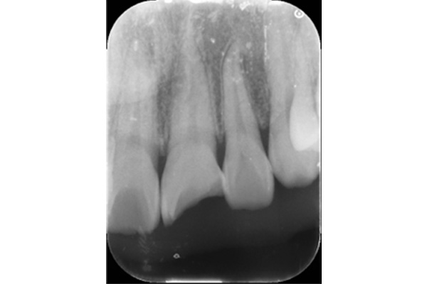 【症例】転倒による前歯外傷に対する審美治療