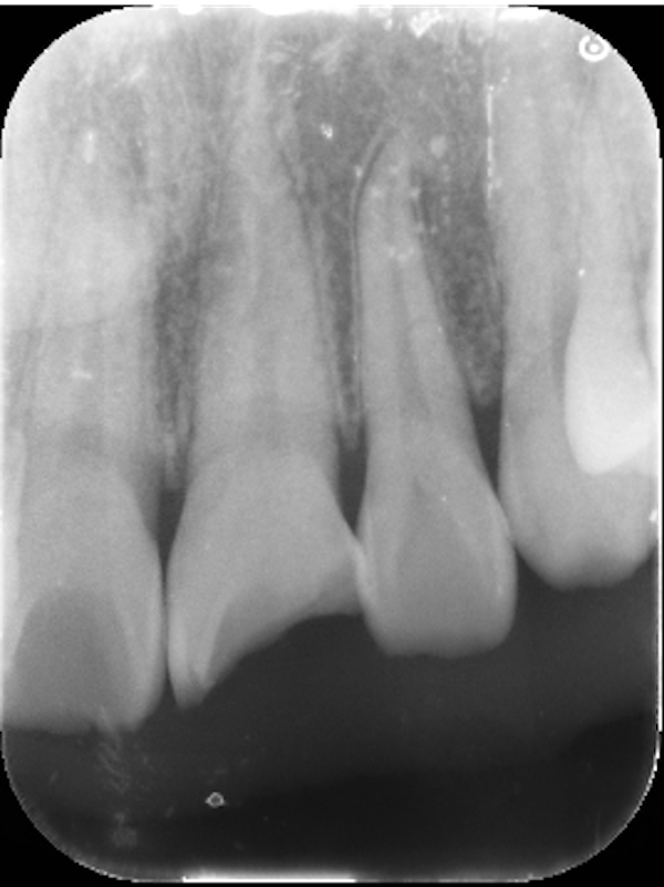 せたがや歯科室ブログ｜転倒による前歯外傷に対する審美治療｜レントゲン画像_治療前1