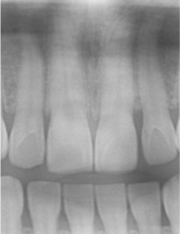 せたがや歯科室|ブログ｜転倒による前歯外傷に対する審美治療｜事故前のレントゲン画像_治療前3