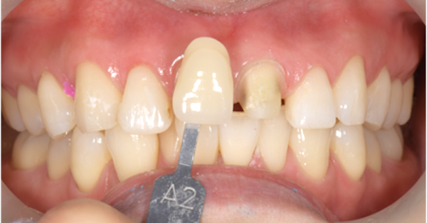 せたがや歯科室|ブログ｜転倒による前歯外傷に対する審美治療｜歯の色味の記録時の画像_治療詳細4