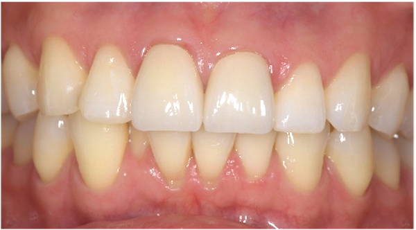 せたがや歯科室|ブログ｜転倒による前歯外傷に対する審美治療｜歯の被せ物完成時の画像_治療詳細6