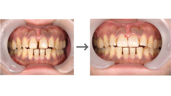 【症例】すきっ歯による審美障害に対する保険治療