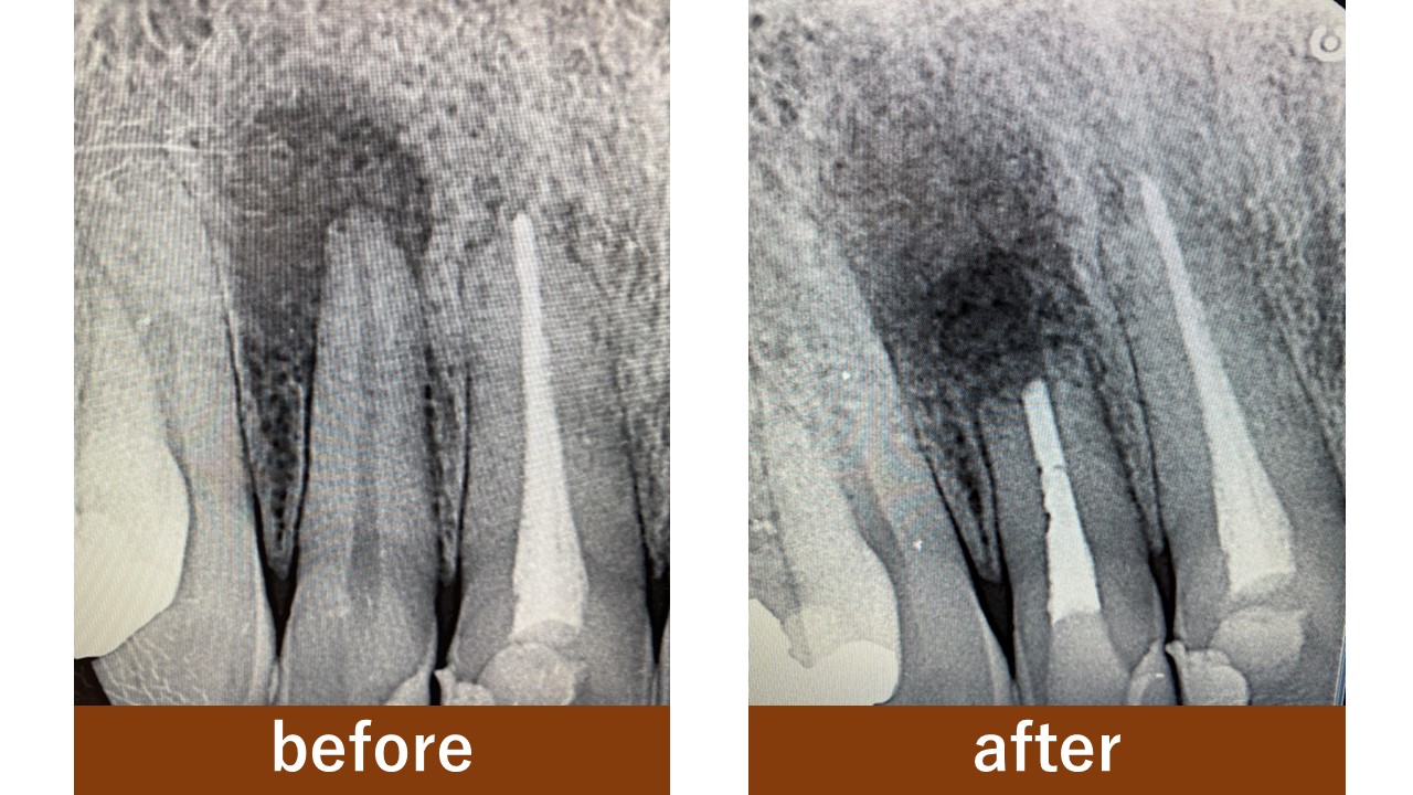 【症例】根管治療で治らない歯根嚢胞に対して行った歯根端切除