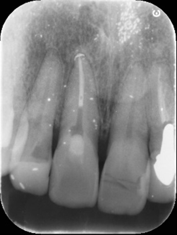 せたがや歯科室｜ブログ｜【症例】破折した歯に対するセラミック治療｜根管治療後のレントゲン画像
