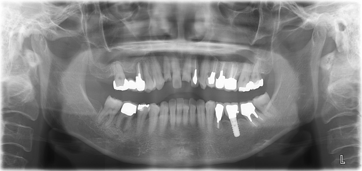 【症例】ケガで破折した歯に対するセラミック治療