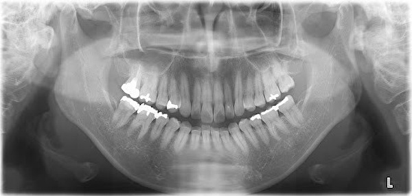 せたがや歯科室｜【症例】銀歯による金属アレルギーに対するセラミック治療｜レントゲン写真