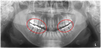 せたがや歯科室｜【症例】銀歯による金属アレルギーに対するセラミック治療｜銀歯のレントゲン写真
