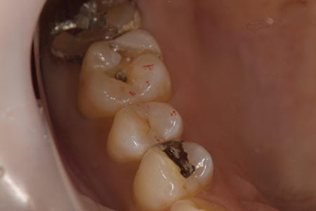 せたがや歯科室｜【症例】銀歯による金属アレルギーに対するセラミック治療｜右上の奥歯の写真