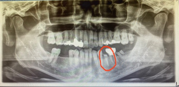 せたがや歯科室｜【症例】虫歯が大きく抜歯適応の歯を、挺出（部分矯正）により保存｜治療前のレントゲン画像