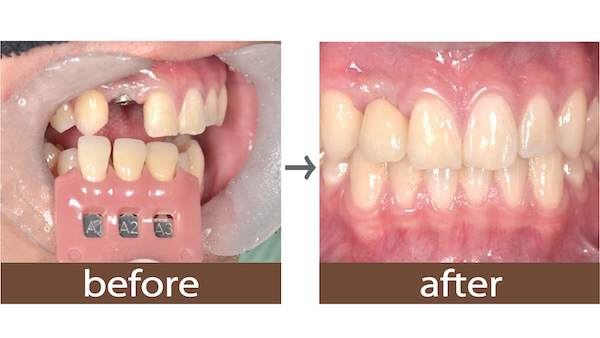 せたがや歯科室｜ブログ｜【症例】前歯のインプラントに対するジルコニアオールセラミック治療｜治療前後の歯の比較画像