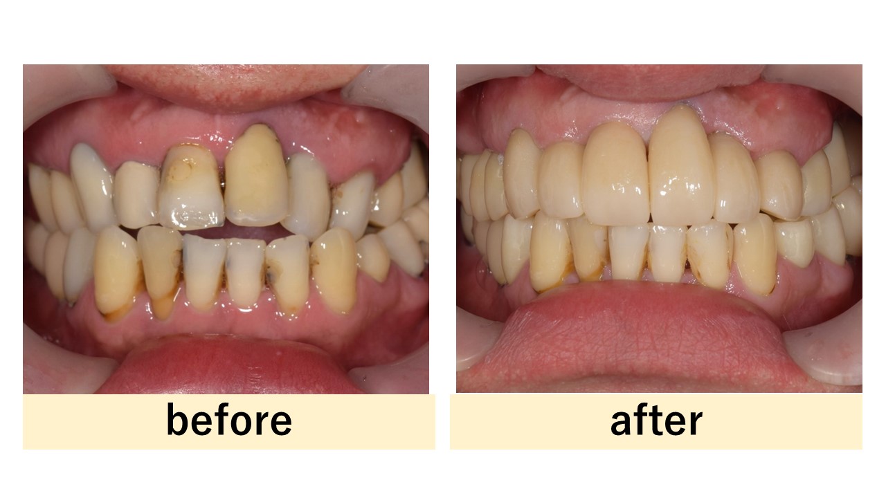 せたがや歯科室｜ブログ｜【症例】セラミックによる前歯の審美的矯正治療｜治療前治療後の比較写真
