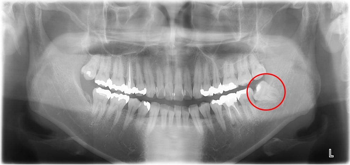せたがや歯科室｜【症例】傾斜した親知らずの抜歯治療｜抜歯前のレントゲン画像メイン