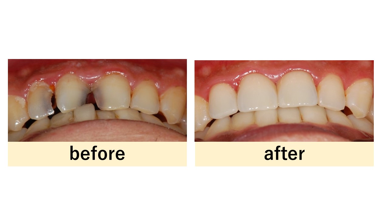 【症例】前歯の虫歯に対して被せ物とホワイトニングを併用した審美の回復