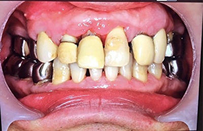 松陰神社前-せたがや歯科室｜【症例】薬の副作用で歯ぐきが腫れた患者の治療｜治療過程の画像