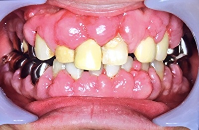 松陰神社前-せたがや歯科室｜【症例】薬の副作用で歯ぐきが腫れた患者の治療｜治療前の画像