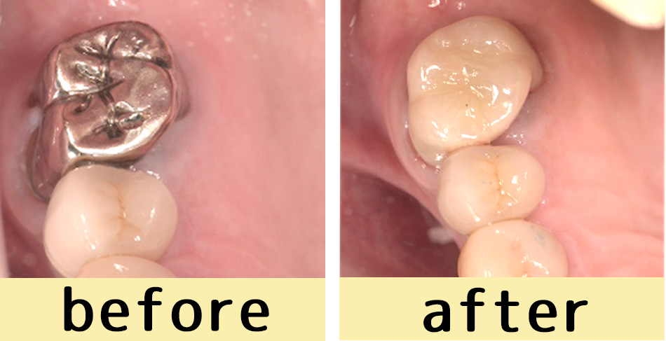 【症例】奥歯に対するジルコニアオールセラミック治療
