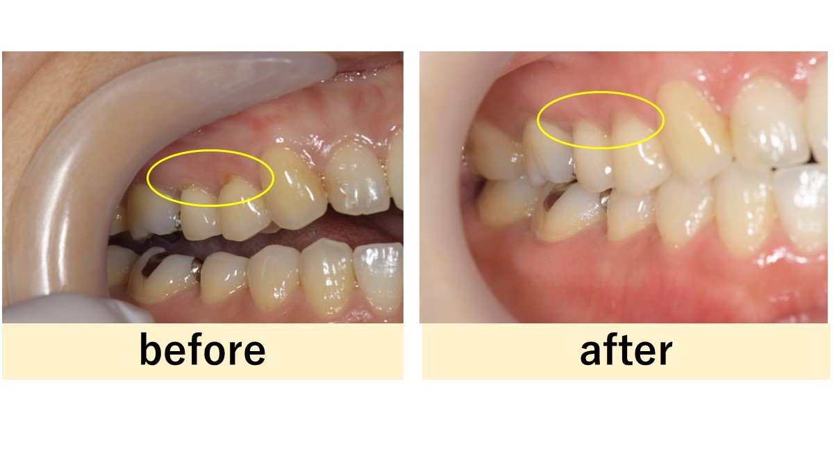 【症例】歯ぎしり食いしばりにより歯がしみる症状に対する処置