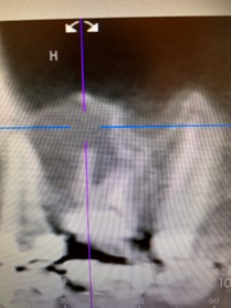 【症例】右上奥歯抜歯後の骨造成とインプラント｜治療前のレントゲン画像２｜松陰神社前の歯医者 せたがや歯科室