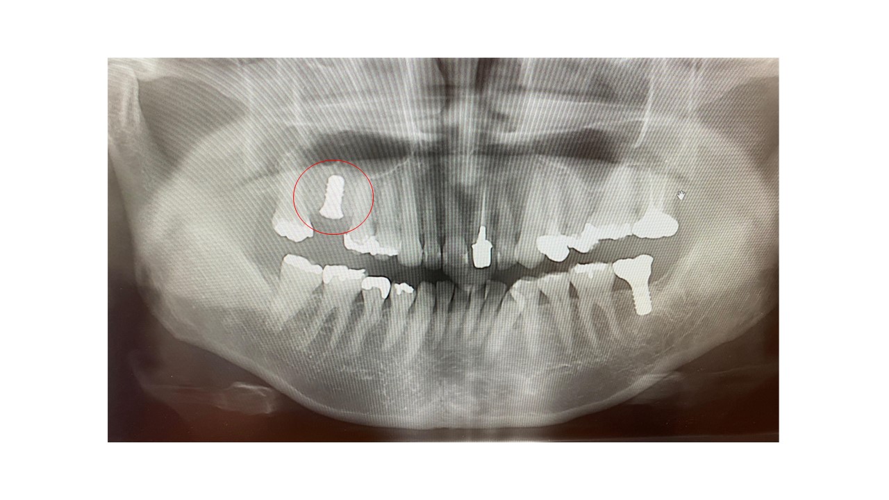 【症例】右上奥歯抜歯後の骨造成とインプラント｜治療後のレントゲン画像｜松陰神社前の歯医者 せたがや歯科室