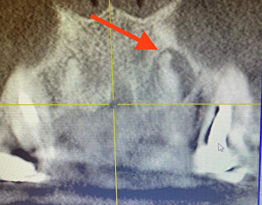 CTの画像｜【症例】歯の根の虫歯に対する再根管治療から被せ物を入れるまでの治療｜せたがや歯科室