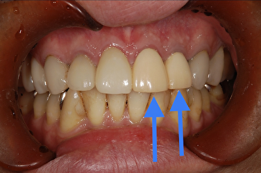 仮歯の写真｜【症例】歯の根の虫歯に対する再根管治療から被せ物を入れるまでの治療｜せたがや歯科室