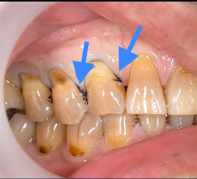 せたがや歯科室｜ブログ｜【症例】知覚過敏を保険適用の治療で改善｜治療中の歯の画像