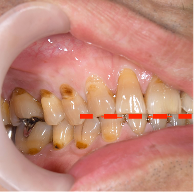 せたがや歯科室｜ブログ｜【症例】知覚過敏を保険適用の治療で改善｜治療前の歯の画像