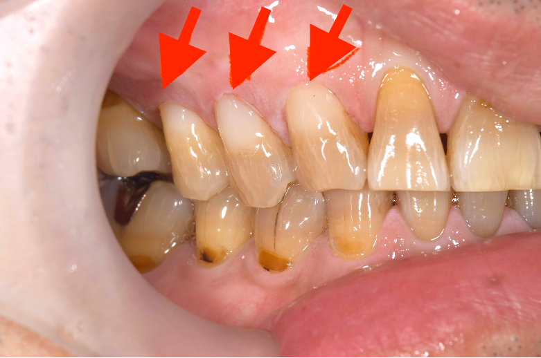 せたがや歯科室｜ブログ｜【症例】知覚過敏を保険適用の治療で改善｜治療後の歯の画像2