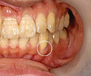 せたがや歯科室｜ブログ｜「知覚過敏」のメカニズムと予防法・治療法について解説｜歯茎が下がった画像