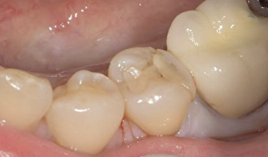 せたがや歯科室｜【症例】ひび・着色がある古いセラミックの下の虫歯治療とセラミックのやり替え｜治療前の歯の画像