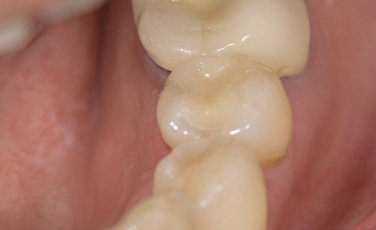 せたがや歯科室｜【症例】ひび・着色がある古いセラミックの下の虫歯治療とセラミックのやり替え｜治療後の画像