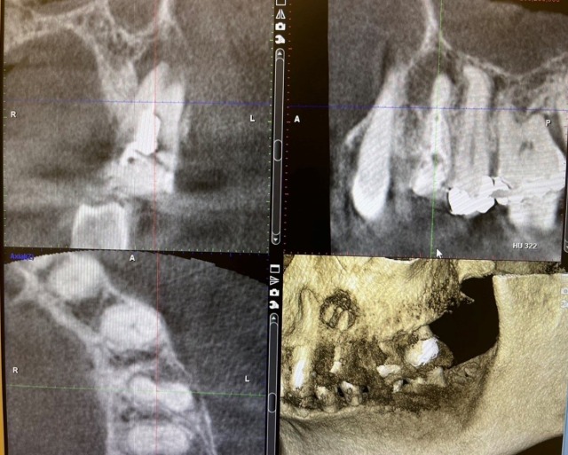 治療前CT画像｜【症例】歯の根の虫歯に対する再根管治療から被せ物を入れるまでの治療｜せたがや歯科室