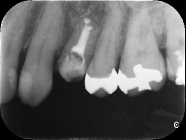治療後レントゲンの画像｜【症例】歯の根の虫歯に対する再根管治療から被せ物を入れるまでの治療｜せたがや歯科室