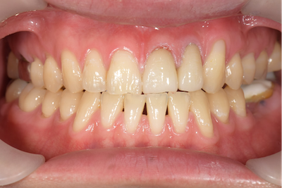 せたがや歯科室｜症例｜【症例】歯の変色に対するセラミック治療｜治療後の画像