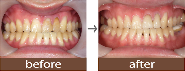 せたがや歯科室｜症例｜【症例】歯の変色に対するセラミック治療｜治療前後の比較画像