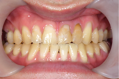 せたがや歯科室｜症例｜【症例】歯の変色に対するセラミック治療｜治療前の画像